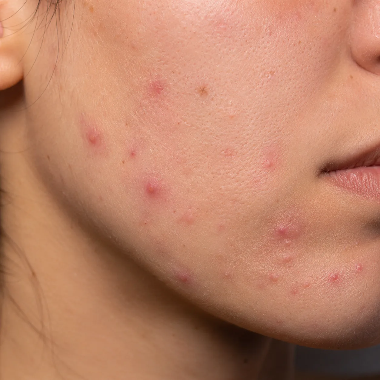 Patiente adulte avec acné — consultation Dermelia Marseille