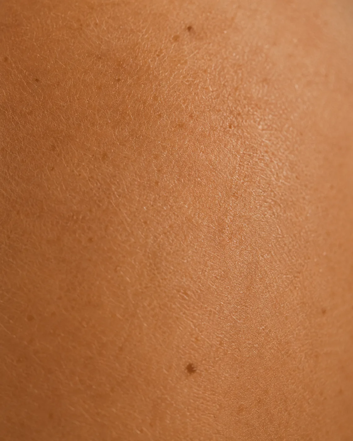 Détatouage laser Hollywood Spectra Dermelia