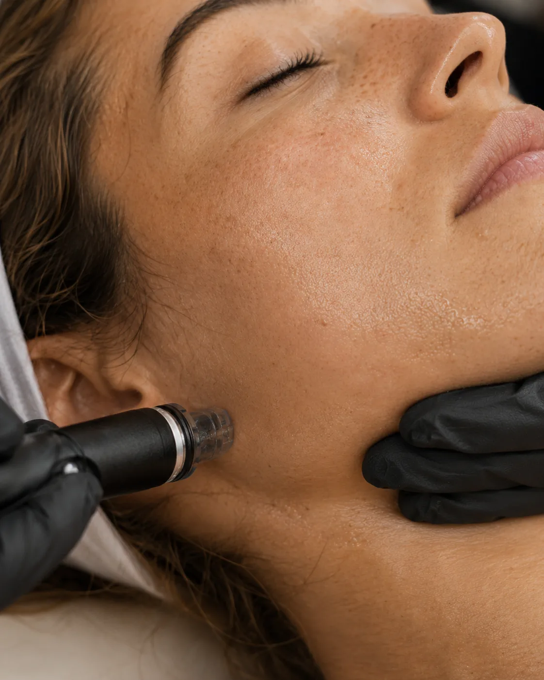Peeling kératolytique — affinage de la couche cornée